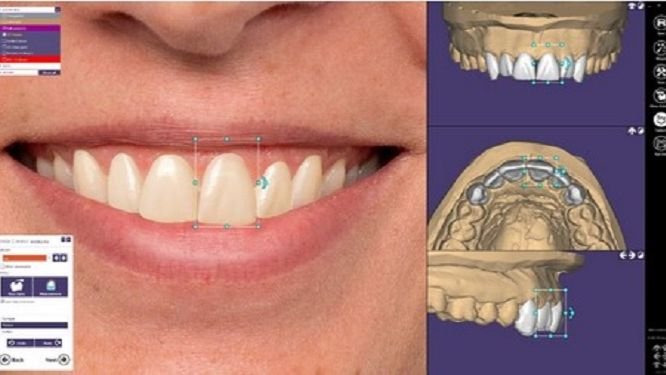 3D smile design software in use